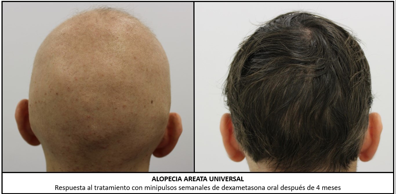 David Saceda - Dermatólogo - Tricólogo - Alopecia - Trasplante de pelo - Madrid - Clínica Grupo Pedro Jaen | cura alopecia areata total universal calvas barba calva masculina hombre