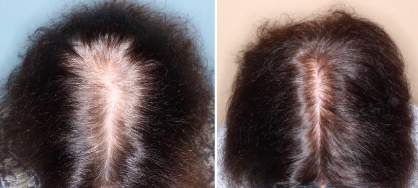 Doctor David - Dermatólogo - Tricólogo - Alopecia - Trasplante de pelo - Madrid - Clínica Grupo Pedro Jaen | minoxidil oral pastillas comprimidos cápsulas solución alopecia masculina hombre