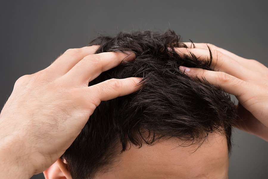 David Saceda - Dermatólogo Tricólogo - Alopecia - de pelo - Madrid - Clínica Grupo Pedro Jaen como usar el minoxidil en locion espuma tratamiento alopecia masculina hombre