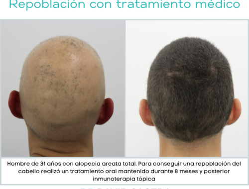 alopecia areata baricitinib