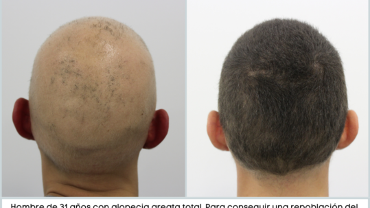 alopecia areata baricitinib